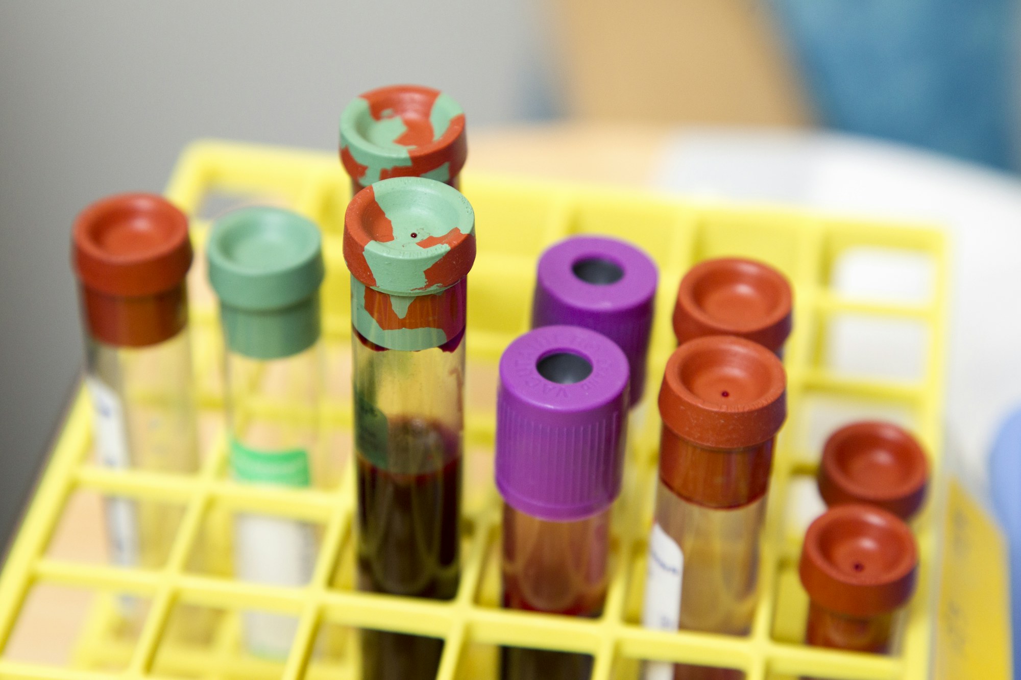 Capped sample tubes standing in a yellow rack at a clinical centre